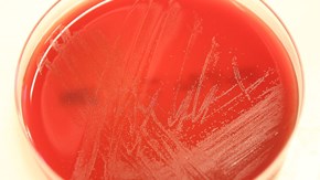 Rödsjuka orsakad av bakterien Erysipelothrix rhusiopathiae 